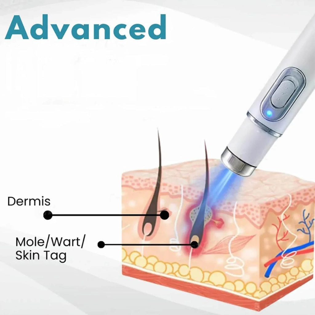 Non-Invasive Mole and Wart Removal Pen